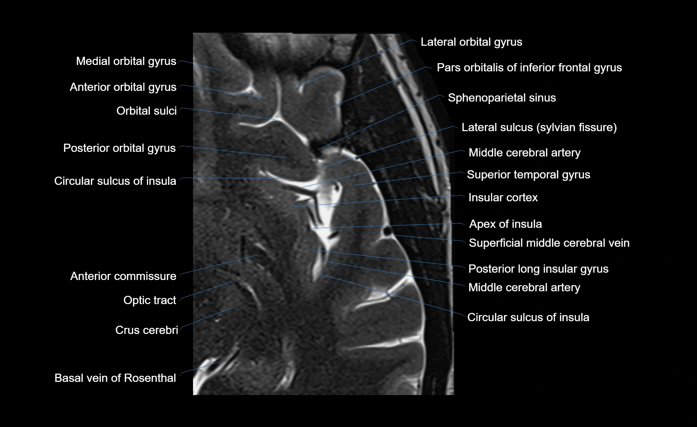 Brain insula axial  anatomy 3T MRI image-img-00001-00005.webp